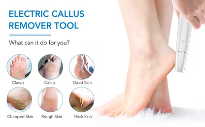 60%off🔥Last Day Special Price £16.99!!💥-🎁Portable Electric Feet Callus Remover (Copy)