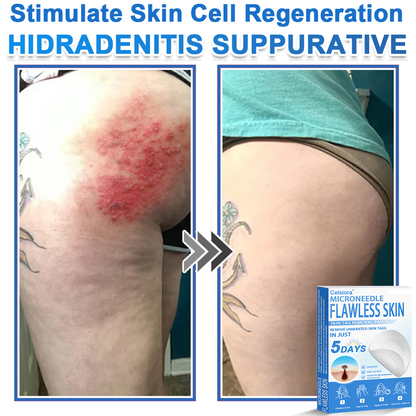 ❤️ Celsiora® 2-in-1 Microneedle & Hydrocolloid Patch | Raised Moles,Acne,  Flat Warts & Skin Tags Remover | Improves Wrinkles, Scars & Blemishes | Invisible Star Pimple Patches for Face & Body