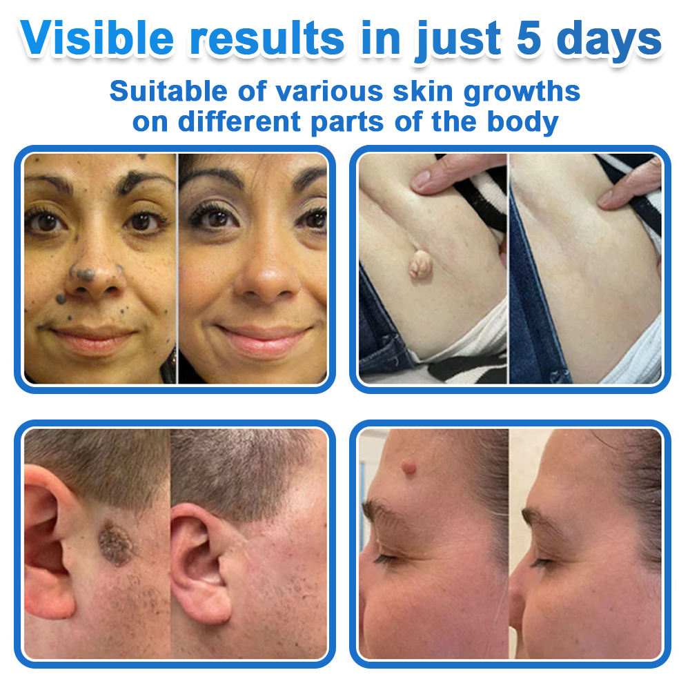 🟢 Celsiora® 2-in-1 Microneedle & Hydrocolloid Patch | Raised Moles,Acne,  Flat Warts & Skin Tags Remover | Improves Wrinkles, Scars & Blemishes | Invisible Star Pimple Patches for Face & Body