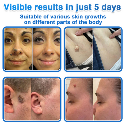 🟢 Celsiora® 2-in-1 Microneedle & Hydrocolloid Patch | Raised Moles,Acne,  Flat Warts & Skin Tags Remover | Improves Wrinkles, Scars & Blemishes | Invisible Star Pimple Patches for Face & Body
