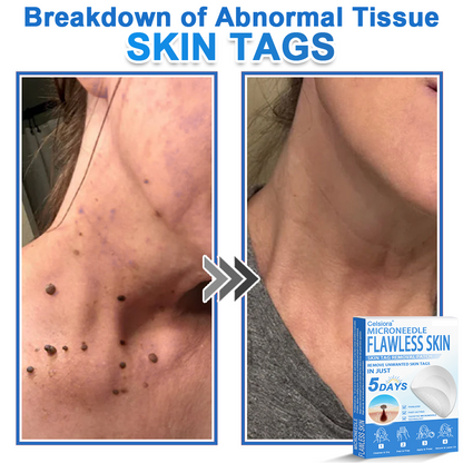 🟢 Celsiora® 2-in-1 Microneedle & Hydrocolloid Patch | Raised Moles,Acne,  Flat Warts & Skin Tags Remover | Improves Wrinkles, Scars & Blemishes | Invisible Star Pimple Patches for Face & Body