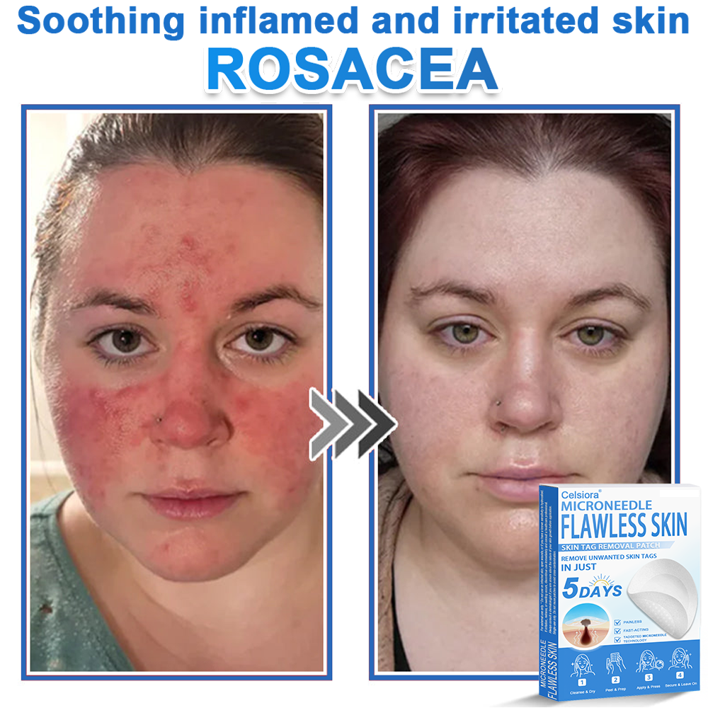 🟢 Celsiora® 2-in-1 Microneedle & Hydrocolloid Patch | Raised Moles,Acne,  Flat Warts & Skin Tags Remover | Improves Wrinkles, Scars & Blemishes | Invisible Star Pimple Patches for Face & Body