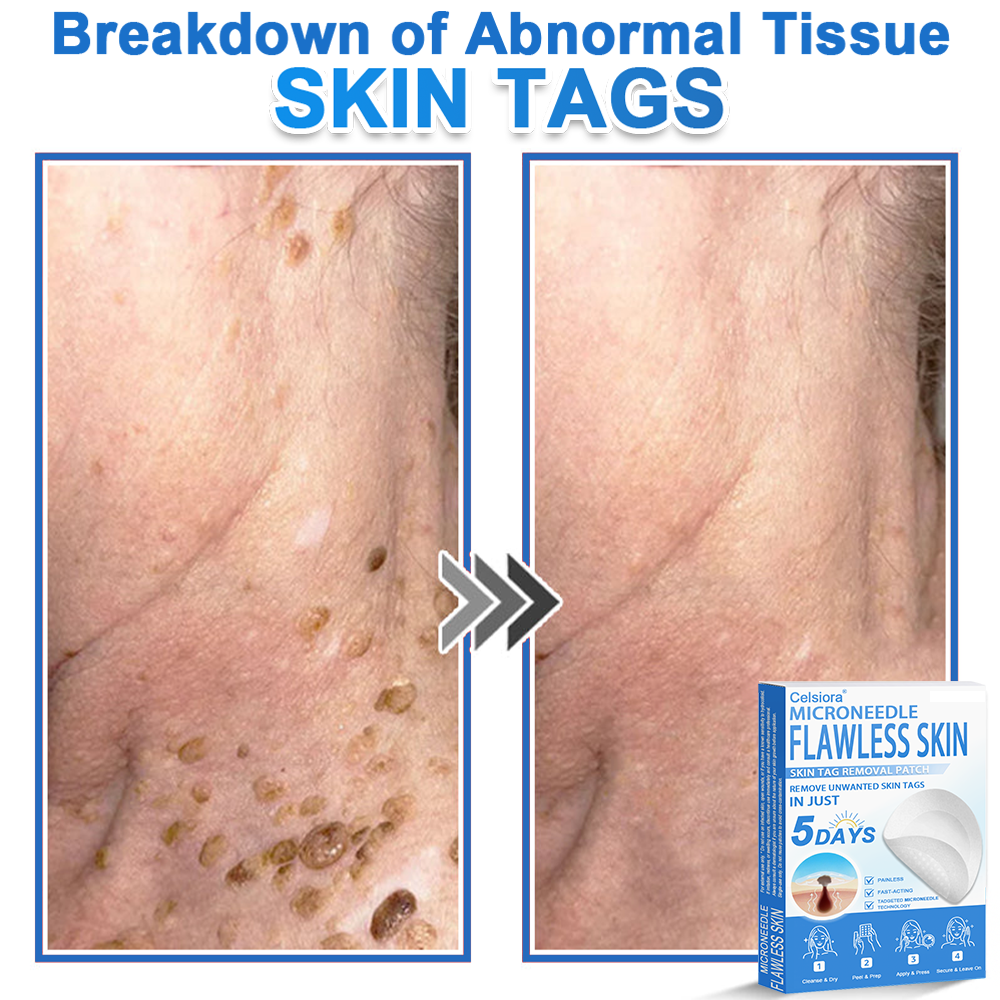 ⏳Celsiora® 2-in-1 Microneedle & Hydrocolloid Patch | Raised Moles,Acne,  Flat Warts & Skin Tags Remover | Improves Wrinkles, Scars & Blemishes | Invisible Star Pimple Patches for Face & Body