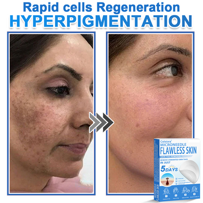 🎁 Celsiora® 2-in-1 Microneedle & Hydrocolloid Patch | Raised Moles,Acne,  Flat Warts & Skin Tags Remover | Improves Wrinkles, Scars & Blemishes | Invisible Star Pimple Patches for Face & Body